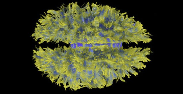 This Isn't a Fright Wig. It's How GE's MRI Scanner Sees Your Brain