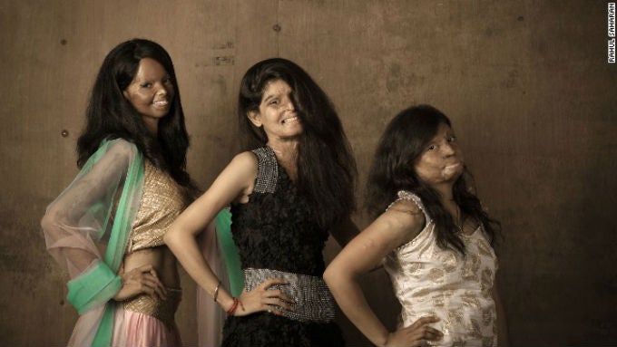 Acid Attack Survivors Model For New Photo Shoot