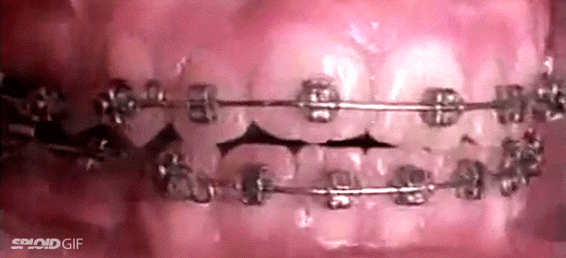 Video How Braces Can Amazingly Straighten Crooked Teeth