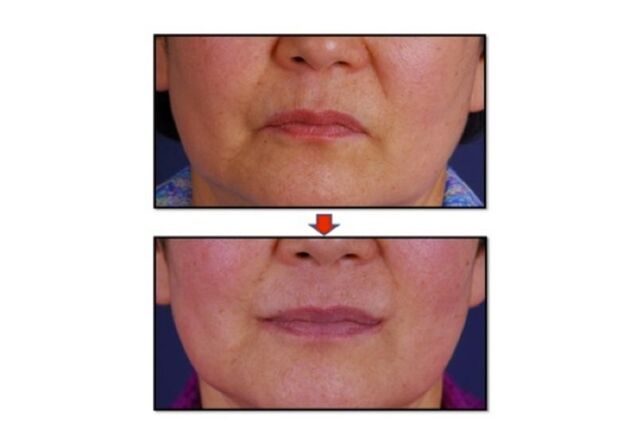 Joker Plastic Surgery? Permanent Duck Faces? I'm Not Sure Which!