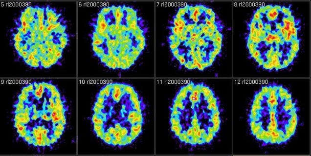 Ultrasound Can Give You Memories of Learning Things in College
