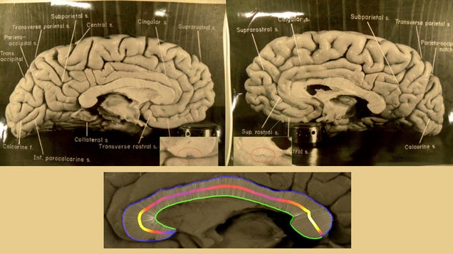 Científicos descubren por qué el cerebro de Einstein era único