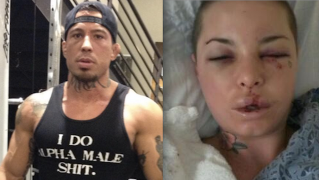 Porn Star Posts Graphic Photos of Brutal Attack By Fighter Ex-Boyfriend