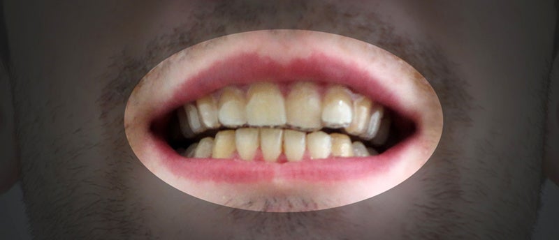 3D Printing Your Own Braces Works, Is a Terrible Idea