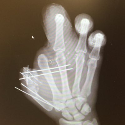 Jason Pierre-Paul Shares X-Ray Of His Hand
