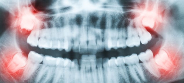 Dentists Found a Pain-Free Cavity Fix That Might Actually Work