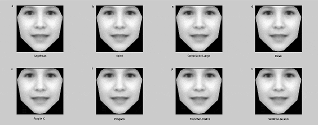 New Software Can Spot Rare Genetic Diseases From Family Photographs