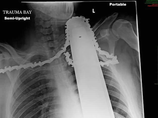 Tree Trimmer &quot;Lucky&quot; to Survive Chainsaw Lodged 2 Inches in Neck