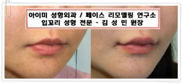 Joker Plastic Surgery? Permanent Duck Faces? I'm Not Sure Which!