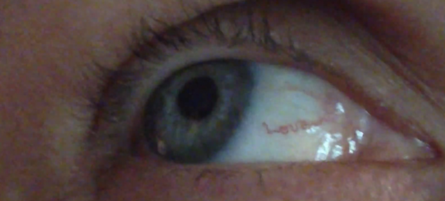 Woman has 'love' written with a blood vessel in her eye