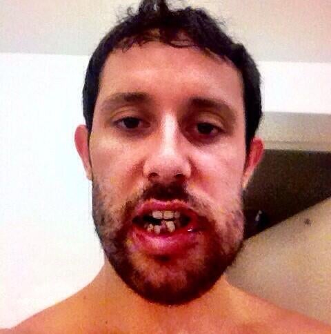 Sam Gagner&#39;s Broken Jaw Is Grotesque - 1915fyvb79zxqjpg