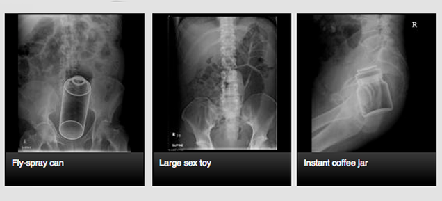 The Site Where Doctors Share X-Rays of Weird Things in People's Butts