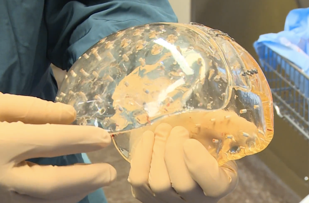 Take a Look at the First Successfully Transplanted, 3D-Printed Skull