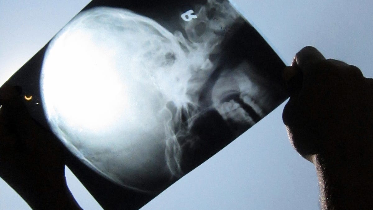 Insurance Types Make a Difference to Survival, For Brian Tumors at Least - Gizmodo