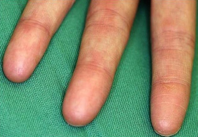Adermatoglifia, la extraña mutación que elimina las huellas dactilares