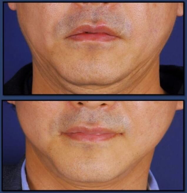 Joker Plastic Surgery? Permanent Duck Faces? I'm Not Sure Which!