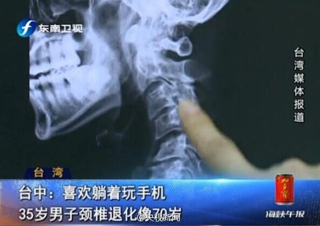 35-Year-Old Man Screws Up His Neck by Playing With His Phone in Bed