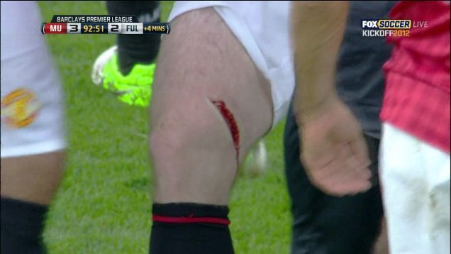 Wayne Rooney Knocked Out Of Match With Gruesome Leg Gash [