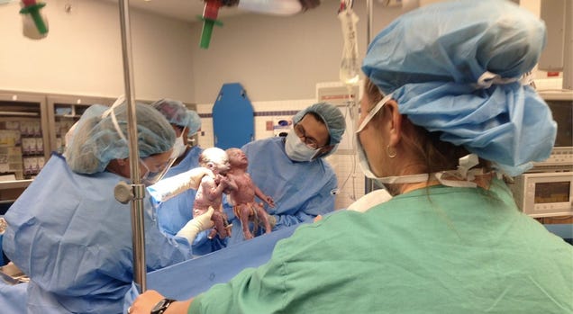 These Rare Newborn "Mono Mono" Twins Held Hands Just After Birth