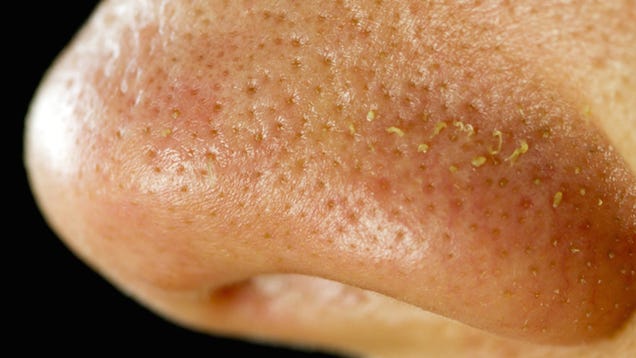 ​There Are Tiny Mites Living in Your Skin Pores and Fucking on Your Face