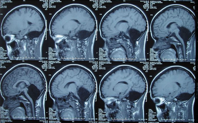 Doctors Discover A Woman With No Cerebellum