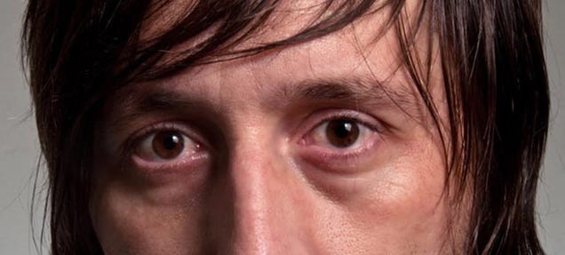 What Causes Dark Circles Under Your Eyes? What Causes Dark Circles Under Your Eyes?