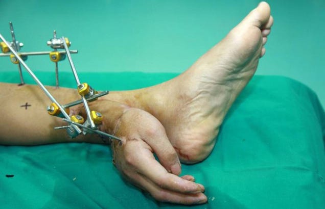Amazing photo of severed hand surgically attached to an ankle