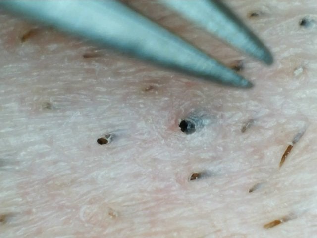 The Ingrown Hair Videos That Were Too Disgusting F