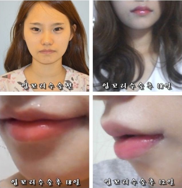 Joker Plastic Surgery? Permanent Duck Faces? I'm Not Sure Which!