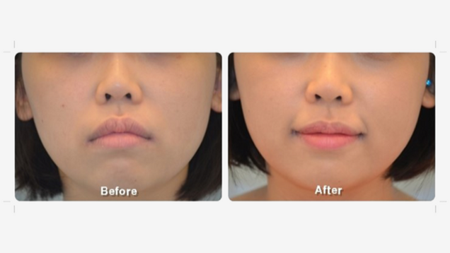 Joker Plastic Surgery? Permanent Duck Faces? I'm Not Sure Which!