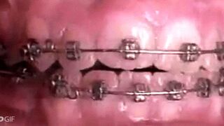 Video: How braces can amazingly straighten crooked teeth