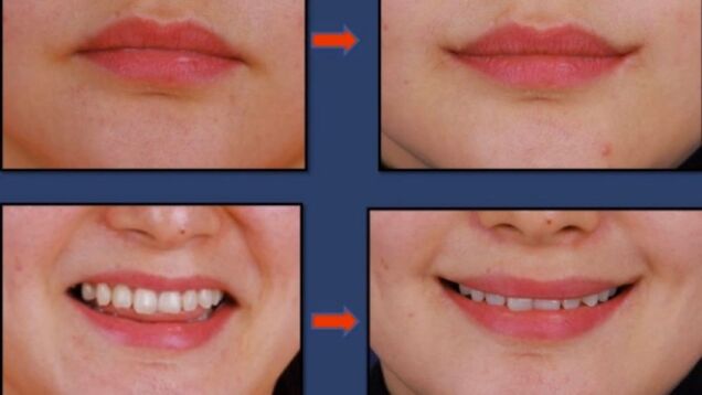 Joker Plastic Surgery? Permanent Duck Faces? I'm Not Sure Which!