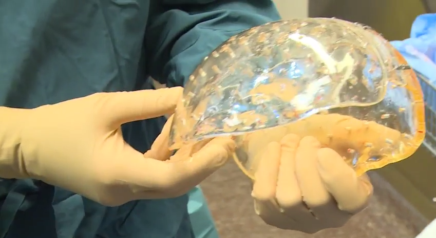 Watch a Woman Get a New 3D-Printed Skull