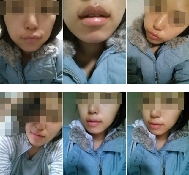 Joker Plastic Surgery? Permanent Duck Faces? I'm Not Sure Which!