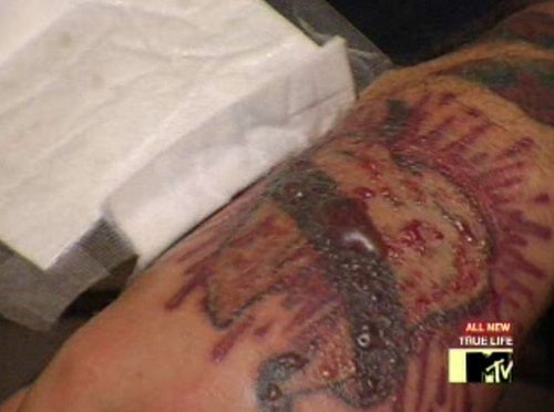 Think Before You Ink: The Painful Process Of Tattoo Removal