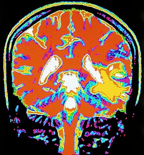 Indian Court Accepts Brain Scans as Evidence of Murder