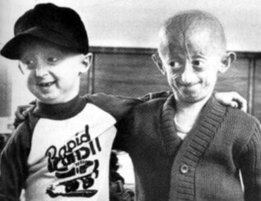 A Cure for Progeria, the Disease that Makes Children Die of Old Age