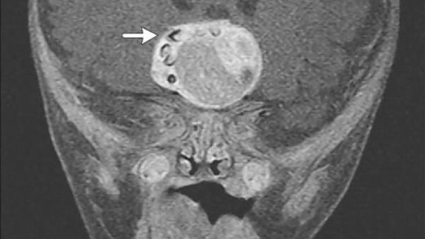 Horrifying Tumor With Teeth Removed from Newborn Baby&#39;s Brain