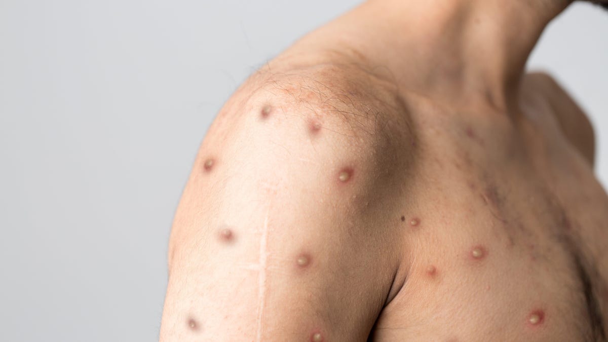 Italian Man With Fever Learns He Has Monkeypox, Covid-19, and HIV All at Once