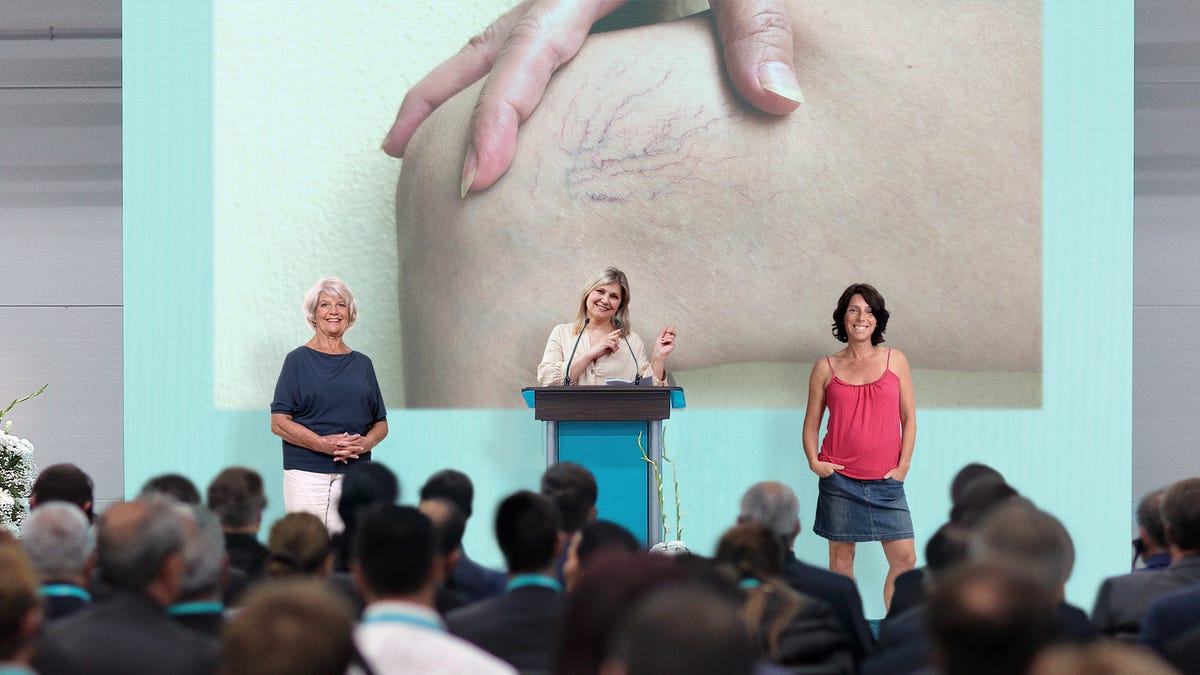 Nation’s Mothers Announce Plans To Show You Their Spider Veins