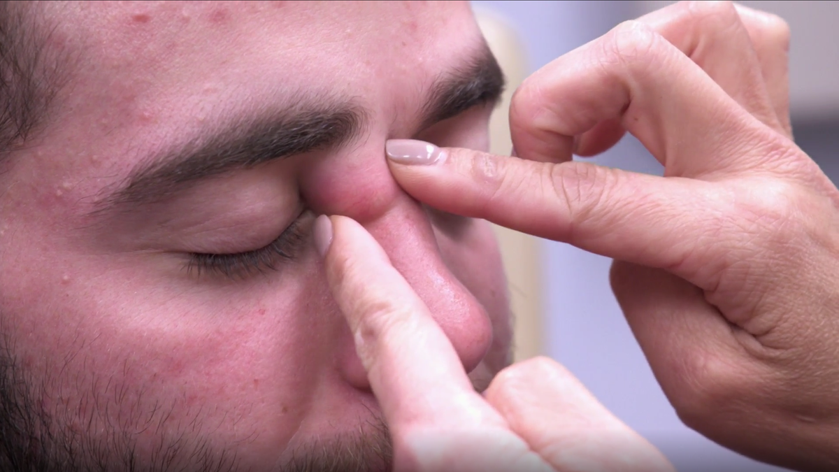 How To Pop A Pimple