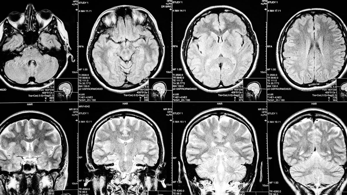 La FDA aprueba lecanemab para la enfermedad de Alzheimer