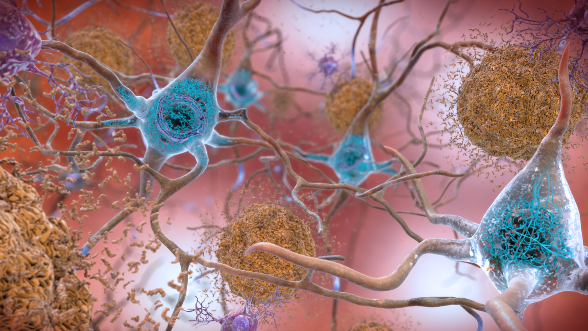 Scientists Find Unusual Form of Iron and Copper in Brains of Alzheimer's Patients - Gizmodo