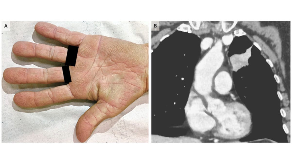 A Woman's 'Velvety' Palms Revealed Her Lung Cancer