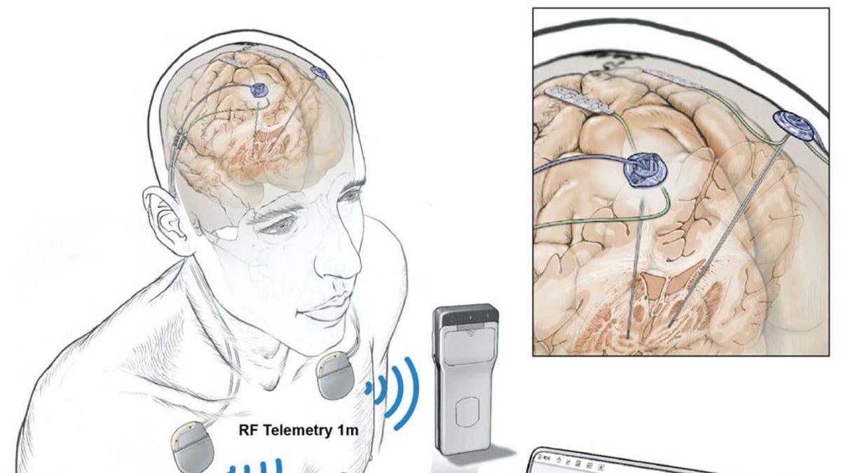 In a First, People Had Their Brain Activity Tracked Remotely During Everyday Life - Gizmodo