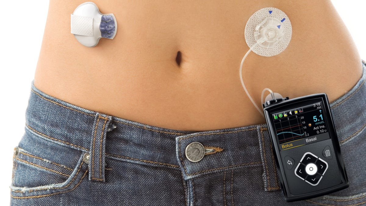 Fda Approves World S First Automated Insulin Pump For Diabetics