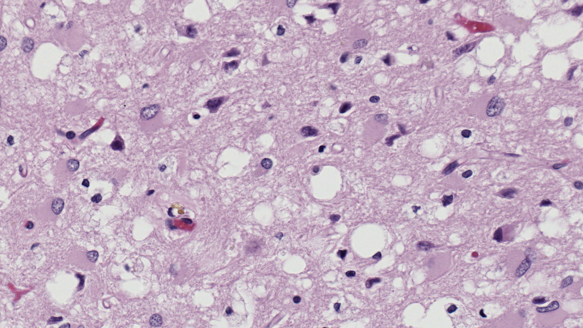 A Brain-Destroying Prion Disease Is Becoming More Common, Study Finds - Gizmodo