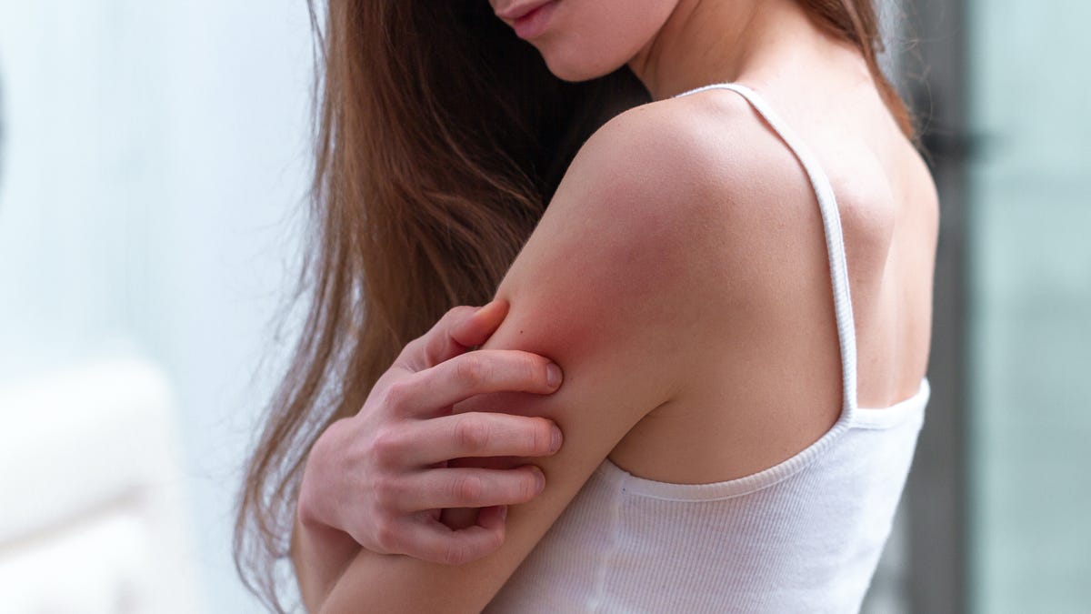 How much do you need to worry about the rash after that vaccination? How much do you need to worry about the rash after that vaccination?