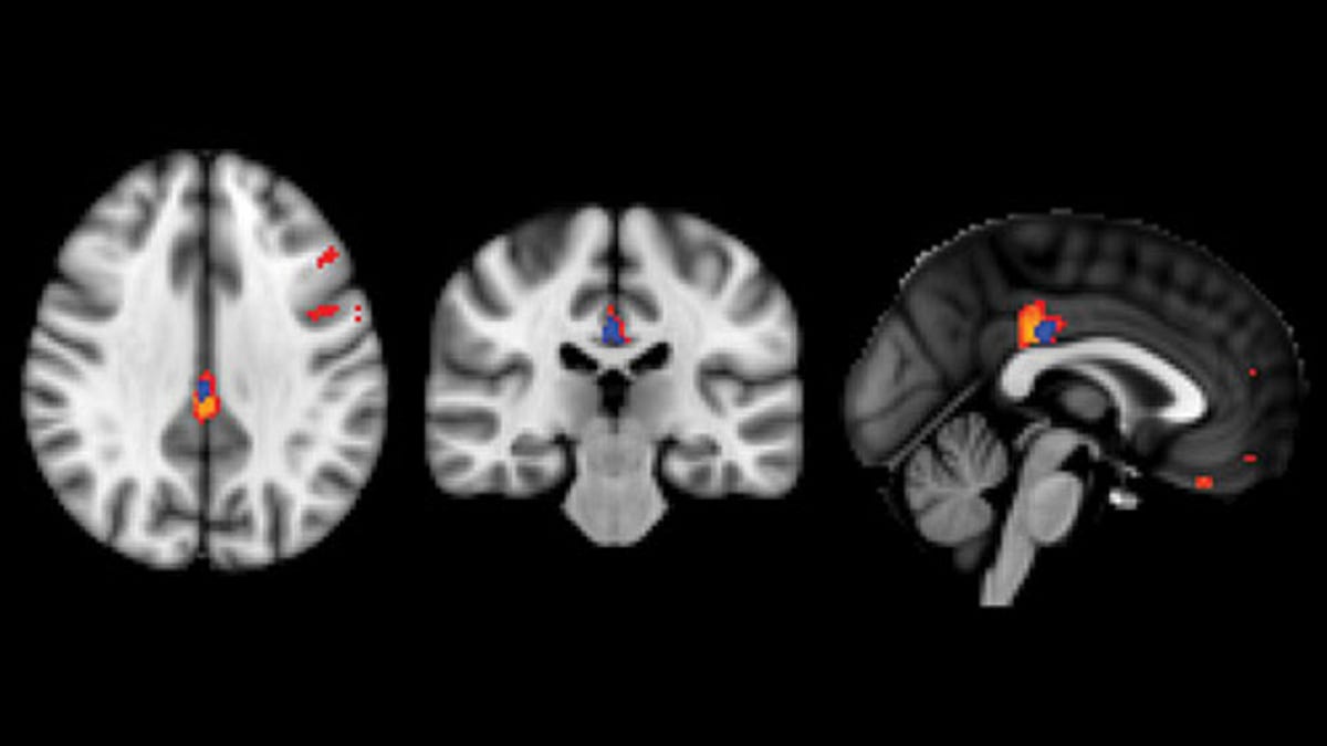 Brain Scans Show Signs Of Cognitive Decline Before Symptoms Appear