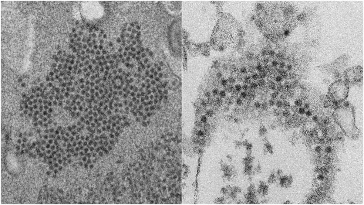 Mysterious Cases of Paralysis in Children May Be Caused by Polio-Like Viruses - Gizmodo thumbnail